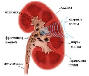 Indicații și contraindicații pentru rinichi litotripsie (indicație) Indicații și contraindicații pentru rinichi litotripsie