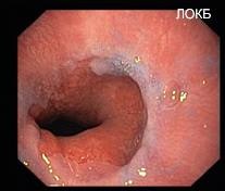 Indicații pentru tratamentul chirurgical al bolii de reflux gastroesofagian (gastroesofagian) Indicațiile pentru tratamentul chirurgical al bolii de reflux gastroesofagian