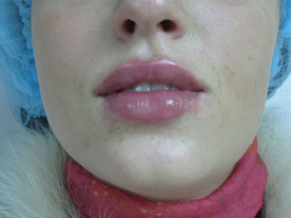 Pompa pentru marirea buzelor (foto) comentarii, video cum să folosească mâinile sale, în cazul în care pentru a cumpara cele mai bune (cumpărare) Pompa pentru marirea buzelor (foto) comentarii, video cum să folosească mâinile sale, în cazul în care pentru a cumpăra cele mai bune