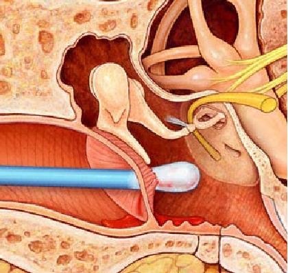 După curățare, a pus urechea ce să facă (ureche a pus curățarea) După curățare, a pus urechea ce să facă