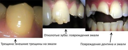 Deteriorarea tipurilor dentare și ce să facă (gingii) Deteriorare a tipurilor de dinți și de ce să facă