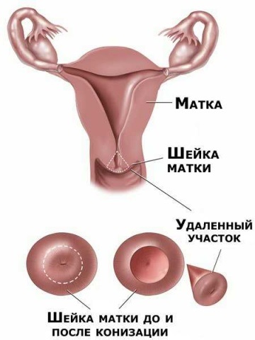 Cauza cancerului de col uterin (cauza) Cauzele cancerului de col uterin