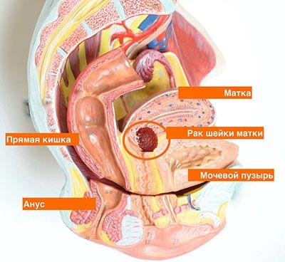 Cauza cancerului de col uterin (cancer de col uterin) Cauzele cancerului de col uterin
