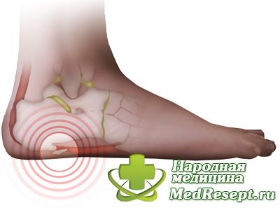 Cauze, simptome si tratamentul flatfoot - sfaturi medicale (cauza) Cauze, simptome și tratament de flatfoot - sfaturi medicale