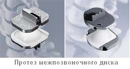Intervertebral disc proteză (protetice discuri intervertebrale) proteză de disc intervertebral