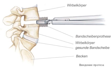 Intervertebral disc proteză (intervertebral) proteză de disc intervertebral