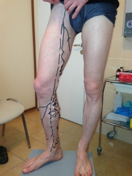 PTFs pas inferioare, clasificare, diagnostic și tratament (membrelor) PTS extremități inferioare etapă, clasificare, diagnostic și tratament