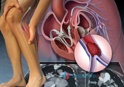 PTS sindromul post-trombophlebitic (boala) a extremităților inferioare - tratament, simptomele (inferior) PTS sindromul post-trombophlebitic (boala) a extremităților inferioare - Tratamentul, Simptome