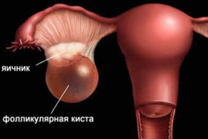 Ruperea un chist ovarian simptome si tratament, ce să facă și consecințele pentru femei (chisturi) Ruperea un chist ovarian simptome si tratament, ce să facă și consecințele pentru femei