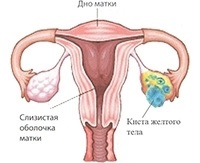 Ruperea un chist ovarian simptome si tratament, ce să facă și consecințele pentru femei (chisturi) Ruperea un chist ovarian simptome si tratament, ce să facă și consecințele pentru femei