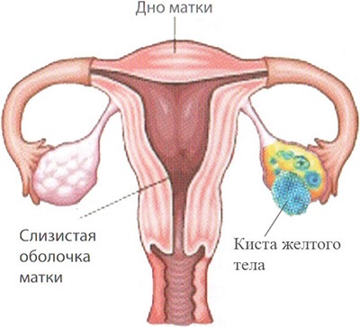 Ruperea un chist ovarian simptome si tratament, ce să facă și consecințele pentru femei (decalajul) Ruperea un chist ovarian simptome si tratament, ce să facă și consecințele pentru femei