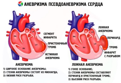 Resuscitarea complicații ale regulilor privind ajutorul de infarct miocardic (eveniment) Resuscitarea complicații ale normelor privind ajutorul de infarct miocardic