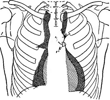 Radiologie pleurezie - referire la un medic TB (diagnostic cu raze X) Radiologie pleurezie - specialiști de referință TB