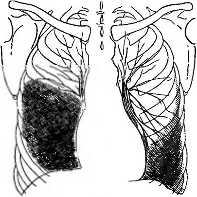 Radiologie pleurezie - (delimitare exterioară interioară a umbrei) referire la un medic TB Radiologie pleurezie - specialiști de referință TB
