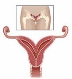 Cauzele salpingo și mecanismul de dezvoltare, principalele semne clinice și simptome, diagnostic (dezvoltare) Cauzele salpingo și mecanismul de dezvoltare, principalele simptome clinice și semne, diagnostic