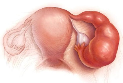Simptomele Salpingo, cauzele si dezvoltarea de tratament (trompe uterine ovare) simptome salpingo, cauzele si tratamentul