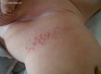 Rash in zona abdomenului, tratament (tratament) Rashes în zona inghinală, tratamentul