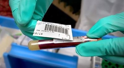 Statinele sunt scăderea colesterolului (în scădere) Statinele sunt reducerea nivelului de colesterol