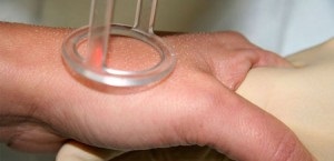 Eliminarea vergeturilor cu laser - comentarii, tratamente, tipuri de compensare (vergeturi) Eliminarea vergeturilor cu laser - comentarii, tratamente, tipuri de corecție