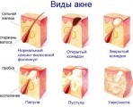 Tipuri de acnee fotografie, steroizi, globulară (sferic) Tipuri de acnee fotografie, steroizi, sferice