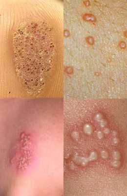 infecții virale ale pielii și mucoaselor (infecție) infecții virale ale pielii și mucoaselor
