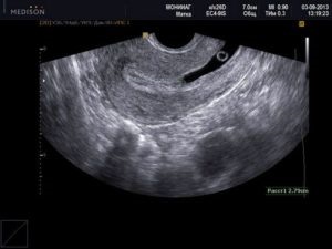 Sarcina ectopică privind eficienta de diagnosticare cu ultrasunete (acest caz uter) Sarcina ectopică privind eficienta de diagnosticare cu ultrasunete