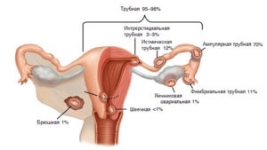 Sarcina ectopică privind eficienta de diagnosticare cu ultrasunete (ectopică) Sarcina ectopică privind eficienta de diagnosticare cu ultrasunete