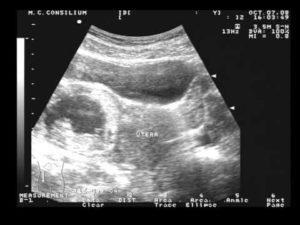 Sarcina ectopică privind eficienta de diagnosticare cu ultrasunete (diagnostic) Sarcina ectopică privind eficienta de diagnosticare cu ultrasunete
