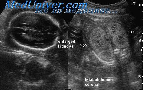 Anomalii ale sistemului urogenital al fetus (sistem) Anomalii ale sistemului urogenital al fătului