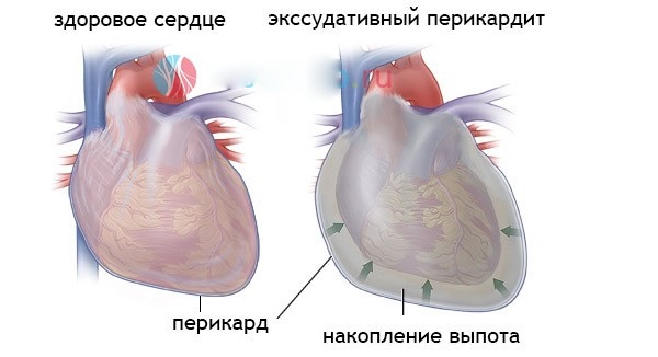 Tratamentul pericardică efuziune, simptome, cauze, simptome (tratament efuziunea pericardica) Pericardului tratament efuziune, simptome, cauze, simptome