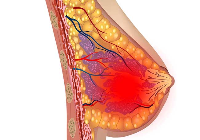 Fibroamele de san - simptome, cauze, prevenire (fibroame) Fibroamele de sân - Simptome, cauze, prevenire