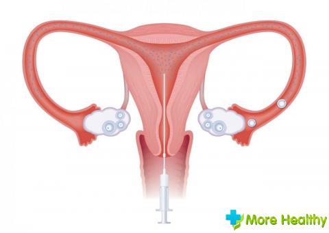hiperplazie endometrială cauzele principale simptome, răzuire (Fidler) Cauzele endometriale Hiperplazia principalele simptome, răzuitoare