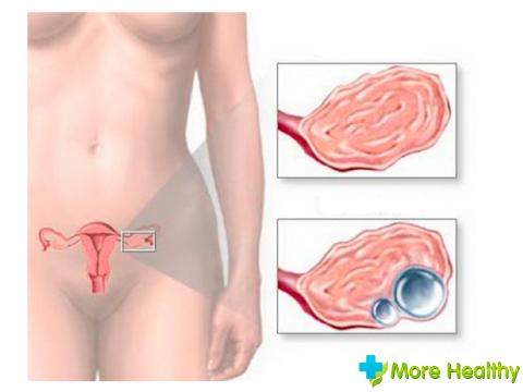 hiperplazie endometrială cauzele principale simptome, răzuire (Fidler) Cauzele endometriale Hiperplazia principalele simptome, răzuitoare