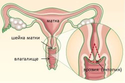 Cum de a trata nulipare eroziune de col uterin (eroziune) Cum de a trata nulipare eroziune de col uterin