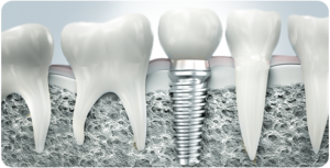 Cum de a calma durerea după implanturi dentare de ce doare dintele vecin după implantare, prim clinici