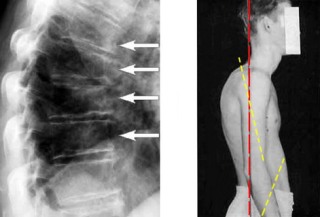 postura Kyphotic si tratament kifoskolioticheskaya (foto)