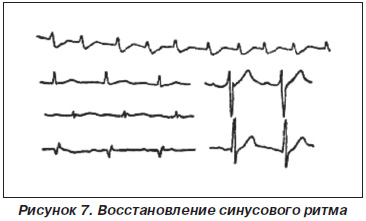 Interpretarea clinică a ECG în diagnosticul bolilor cardiovasculare acute, pre-spital (clinice) Interpretarea clinică a ECG în diagnosticul bolilor cardiovasculare acute în prespital