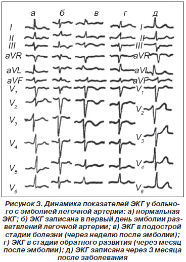 Interpretarea clinică a ECG în diagnosticul bolilor cardiovasculare acute, pre-spital (clinice) Interpretarea clinică a ECG în diagnosticul bolilor cardiovasculare acute în prespital