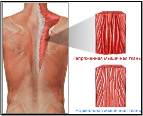 intarziat debutul durere musculara a muschilor