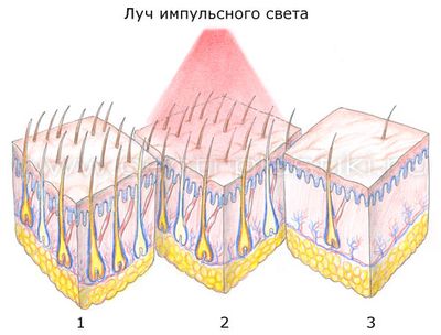 îndepărtarea părului Quantum - ceea ce este, preturi, comentarii, contraindicații, înainte și după fotografii, video (epilarea) îndepărtarea părului Quantum - ceea ce este, preturi, comentarii, contraindicații, înainte și după fotografii, video