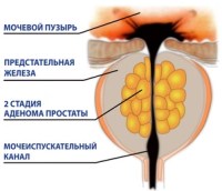 tratamentul BPH terapiei conservatoare si chirurgie