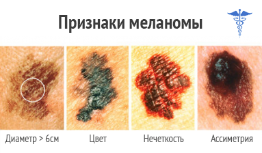 proiecții ale pielii Melanomul de viață, simptome și tratament