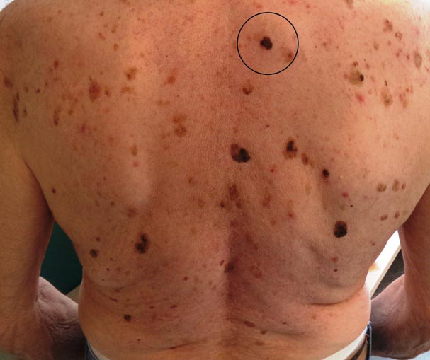 Melanomul pielea de pe spate simptome, cauze și semne, fotografii, modul de a trata specii (spate) Melanomul pielea de pe spate simptome, cauze și semne, fotografii, modul de a trata, specii