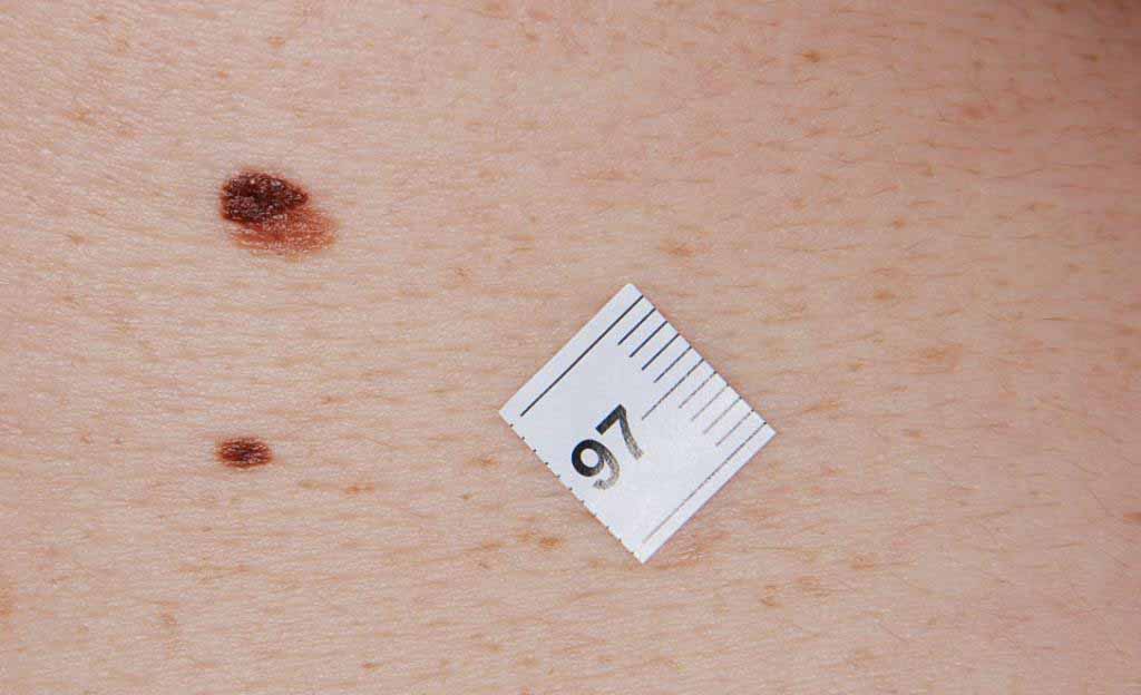 Melanomul pielea de pe spate simptome, cauze și semne, fotografii, modul de a trata, tipuri (melanom) Melanomul pielea de pe spate simptome, cauze și semne, fotografii, modul de a trata, specii