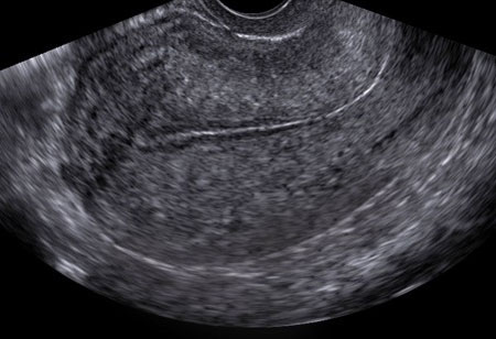 M-ecou al indicatorilor uterului și cervixului normate, decodificarea (colul uterin) M-ecou a indicatorilor uterului si a colului uterin normate, decodarea