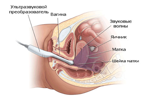 M-echo uterului și cervixului normate metrici, decodare (m-echo) M-ecou a indicatorilor uterului si a colului uterin normate, decodarea
