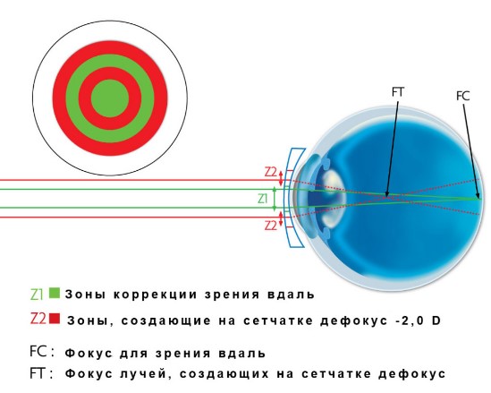 Lentilele de contact este și modul de a face o alegere