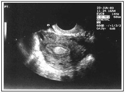 polip endometrial