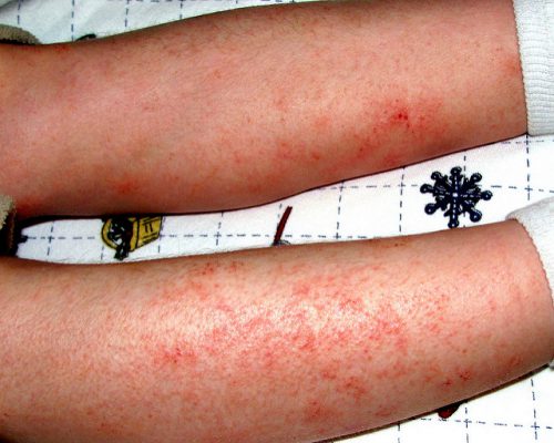 Psoriazis si eczeme sunt diferite de modul de a vindeca (trata) Psoriazis si eczeme sunt diferite de modul de a trata