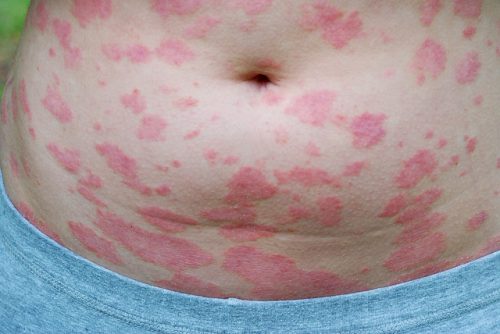 Psoriazis si eczeme difera ca pentru a trata (psoriazis) Psoriazis si eczeme sunt diferite de modul de a trata